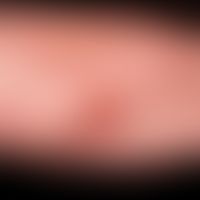 Paraproteinämie&nbsp;und Hautveränderungen: vaskulitische Nekrose bei bekanntem Myelom.&nbsp;
