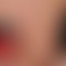 Duftstoffallergie: Kontaktallergie gegenüber einem Duftstoff-haltigen Deodorans&nbsp;
