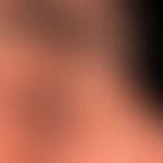 Epidermalzyste: seit&nbsp;Jahren bekannter schmerzloser Knoten. Nebenbefundlich: multiple Komedon...