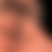 Epidermalzyste: seit&nbsp;Jahren bekannter schmerzloser Knoten. Nebenbefundlich: multiple Komedon...