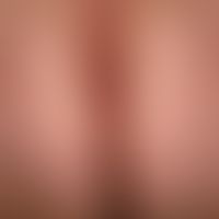 Hidradenitis suppurativa:&nbsp;seit vielen Jahren bestehender, weiterhin noch progredienter Befun...
