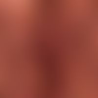 Hidradenitis suppurativa derVulva: seit vielen Jahren bestehender, noch progredienter ausgedehnte...