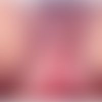 Donovanosis:&nbsp;Lymphödem der Labien. Großflächige schmierige, nicht schmerzhaftes Ulzera. Entn...