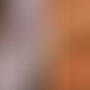 Keratosis linearis mit Ichthyosis congenita und sklerosierendem Keratoderm mit Mutationen in POMP...