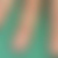 Adermatoglyphie, isolierte kongenitale: komplett fehlende Leistenstrutkur der Finger. Abb. entomm...