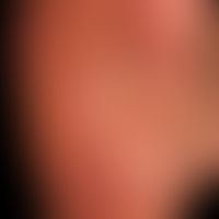 Keratoma sulcatum: disseminierte, wie ausgestanzt wirkende, kleinste Hornschichtdefekte; deutlich...