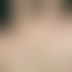 Palmoplantarkeratose punktiert,Typ 2: umschriebene, nicht schmerzhafte Hornpapeln. Interläsionale...