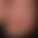Palmoplantarkeratosen (PKK): transgrediente Palmoplantarkeratose mit Mutation in KTR1 (historisch...