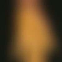 Keratosis palmoplantaris diffusa mit Mutation in Keratin 9: diffuse PKK mit erytehmatösem Randsau...