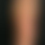 Keratosis palmoplantaris diffusa mit Mutationen in Keratin 1: diffuse transgrediente&nbsp;PKK.

&...