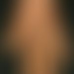 Keratosis palmoplantaris diffusa mit Mutationen in Keratin 1: diffuse transgrediente&nbsp;PKK. Ke...