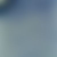 Psoriasis: Munro-Mikroabszess (M): Semidünnschnitt: Neutrophile Leukozyten innerhalb parakeratoti...