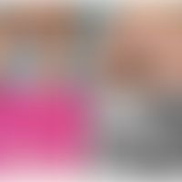 Epidermolytische Ichthyose: Bräunliche Hyperkeratose am Gesäß und in den infraglutealen Falten mi...