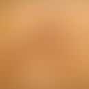 Epidermolytischer Komedonennaevus: bizarr konfiguriertes&nbsp;pigmentiertes&nbsp;epidermales&nbsp...