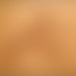 Epidermolytischer Komedonennaevus: bizarr konfiguriertes&nbsp;pigmentiertes&nbsp;epidermales&nbsp...