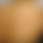 Epidermolytischer Komedonennaevus: bizarr konfiguriertes&nbsp;pigmentiertes&nbsp;epidermales&nbsp...
