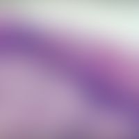 Epidermolytischer Komedonennaevus: geringe Akanthose mit Orthohyperkerathose. Fokale Akantholyse....