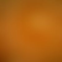 Dyshidrotische Dermatitis: Bläschen auf der Leistenhaut, Auflichtmikroskopie
