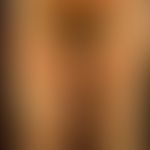 Psoriasis pustulosa generalisata, akut exazerbiert
