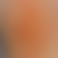 Erythema infectiosum:&nbsp;teils anuläre teils retikuläre Erytheme an der unteren Extremität.&nbsp;
