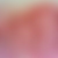 Dyskeratosis follicularis. Akantholytische Zellen intraepidermal mit Spaltbildung
