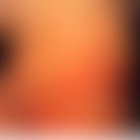 Dyskeratosis follicularis. postnatal aufgetretene rötliche, erhabene, zu Plaques konfluierende Pa...