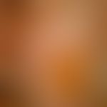 Gustatorische Hyperhidrose: Mit dem Minorschen Schwitzversuch nachgewiesene lokalisierte Hyperhid...