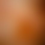 Gustatorische Hyperhidrose: Mit dem Minorschen Schwitzversuch nachgewiesene lokalisierte Hyperhid...