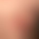 Initialer Herpes zoster am Rücken eines 30-jährigen Mannes mit charakteristischem klinischen Bild...