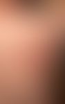Initialer Herpes zoster am Rücken eines 30-jährigen Mannes mit charakteristischem klinischen Bild...