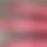 Porokeratosis Mibelli. Scharfe Begrenzung mit Randwall - streckseitig an den Fingern. S. auch zuv...