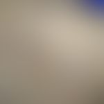 Porokeratosis linearis unilateralis:&nbsp;streifenförmige keratotische Paplen. Abbn. entommen aus...