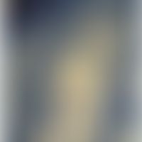 Papillarkörper mit enthaltener Kapillare (Lumen rot markiert) und entzündlichem Infiltrat; Semidü...