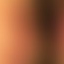 Porokeratom: typischer Befund des Porokeratoms. Feste, halbkugelige, bräunliche Knoten. Abb. nach...