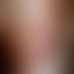 Dyskeratosis follicularis:&nbsp; Braun-rötliche, z.T. konfluierende Papeln mit deutlicher Verhorn...