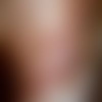 Dyskeratosis follicularis:&nbsp; Braun-rötliche, z.T. konfluierende Papeln mit deutlicher Verhorn...