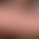 Blau-Syndrom: lichenoide Dermatitis. Abb. entnommen aus Medical News Today
