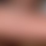 Blau-Syndrom: lichenoide Dermatitis. Abb. entnommen aus Medical News Today
