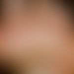 Clavi psoriatici: umschriebene Hyperkeratosen an der Fußsohle. Im Gegensatz zu Verrucae plantares...