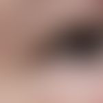 Hidrozystom: Frau, 52 Jahre. subj. symptomloses derbes Knötchen Lidkante seit ca. 1 Jahr. Da bere...