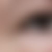 Hidrozystom: Frau, 52 Jahre. subj. symptomloses derbes Knötchen Lidkante seit ca. 1 Jahr. Da bere...