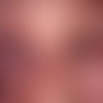Erythrodermie (psoriatische): universelle Rötung des Gesichtes sowie Schuppung im Gesichtbei eryt...