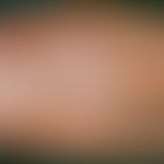 Erythrodermie: universelle Rötung auch der Hand bei erythrodermischer Psoriasis.
