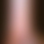 Epidermolysis bullosa simplex, Weber-Cockayne,&nbsp; schmerzlose Blase hinter dem Außenknöchel na...