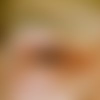 Eccema herpeticatum mit Impetiginisierung am Auge

