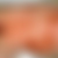 Epidermolysis bullosa dystrophica rezessiv, generalisiert intermediär: Ausgedehnte Blasenbildung ...