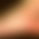 Naevus flammeus (Port-wine stain): Scharf begrenzter roter Gefäßnaevus lateral am Fuß.
