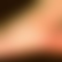 Naevus flammeus (Port-wine stain): Scharf begrenzter roter Gefäßnaevus lateral am Fuß.
