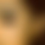 Naevus fuscocoeruleus ophthalmomaxillaris:&nbsp;&nbsp; linke Wange, bis zum Auge reichend bei bei...