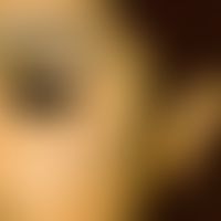 Naevus fuscocoeruleus ophthalmomaxillaris:&nbsp;&nbsp; linke Wange, bis zum Auge reichend bei bei...